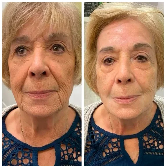 Before and after facial treatment result 2