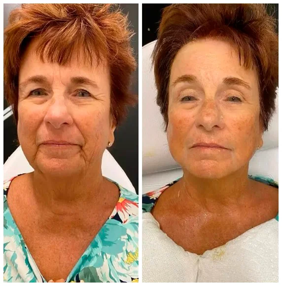 Before and after facial treatment result 1