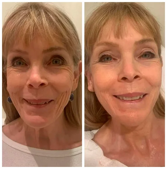 Before and after facial treatment result 3