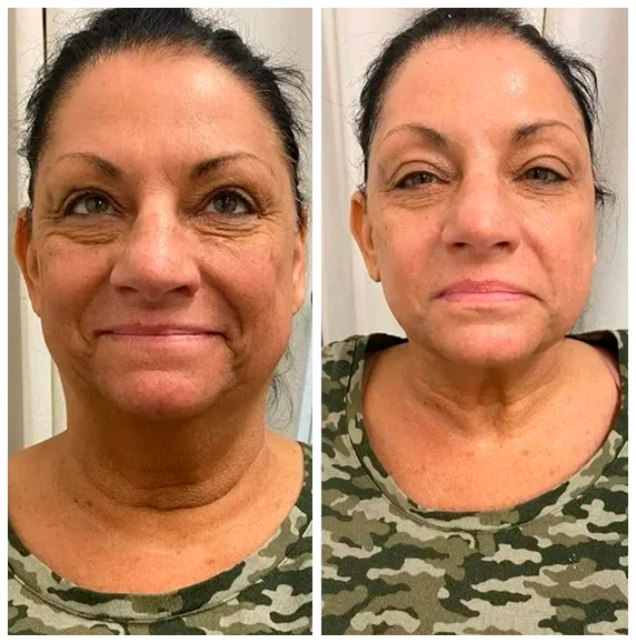 Before and after facial treatment result 4