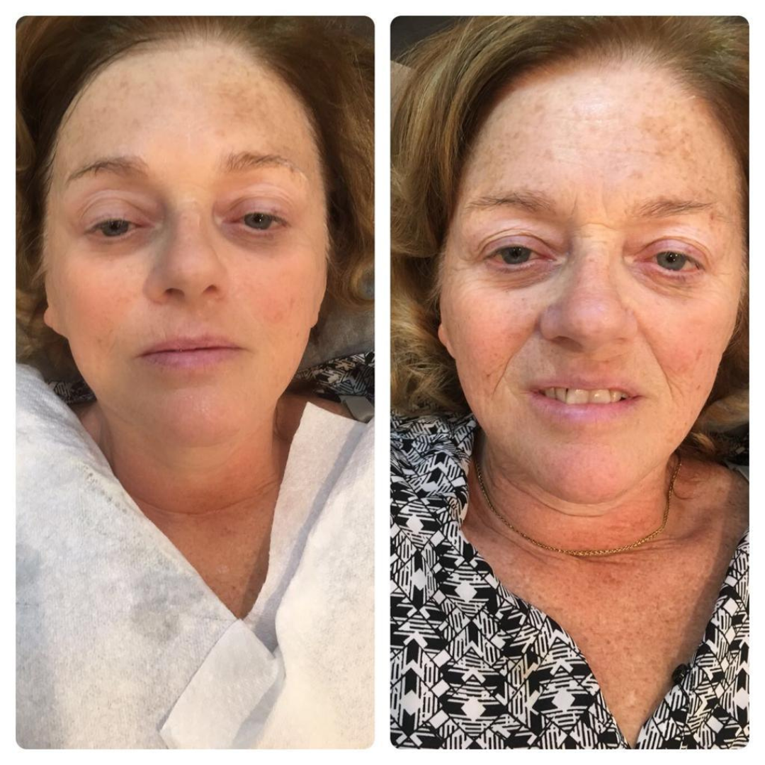 Before and after LED treatment result 1