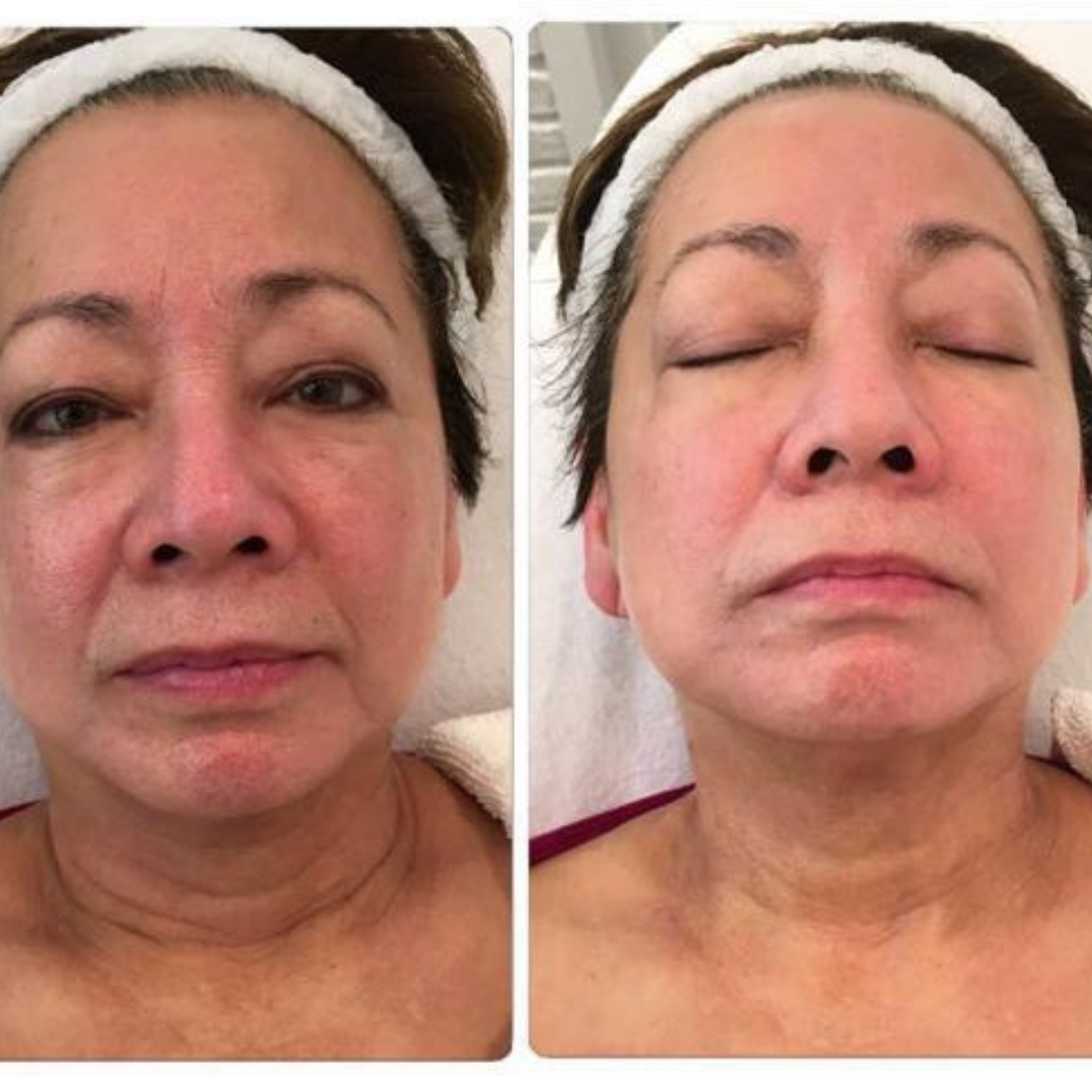 Before and after LED treatment result 2