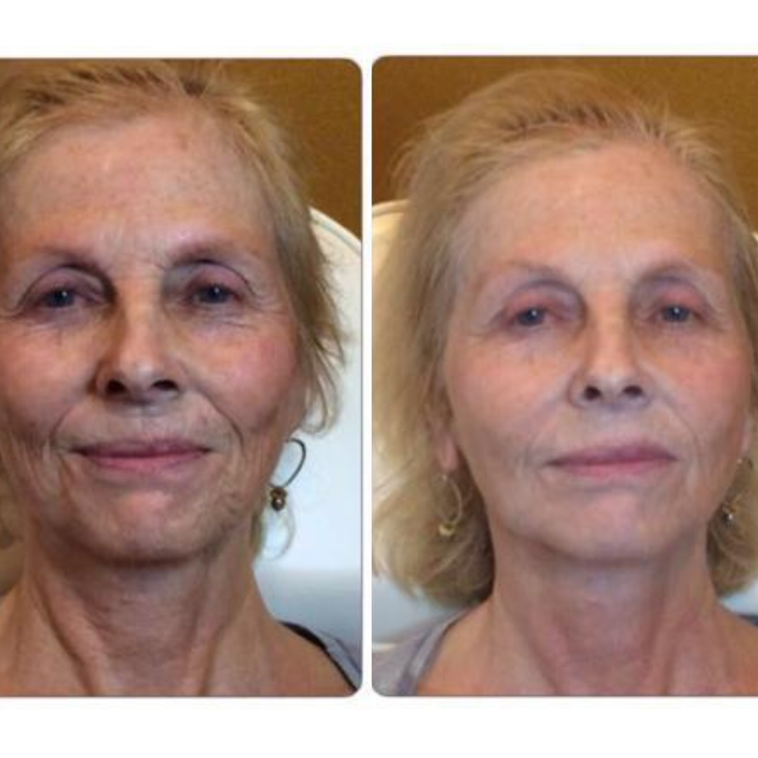 Before and after LED treatment result 3