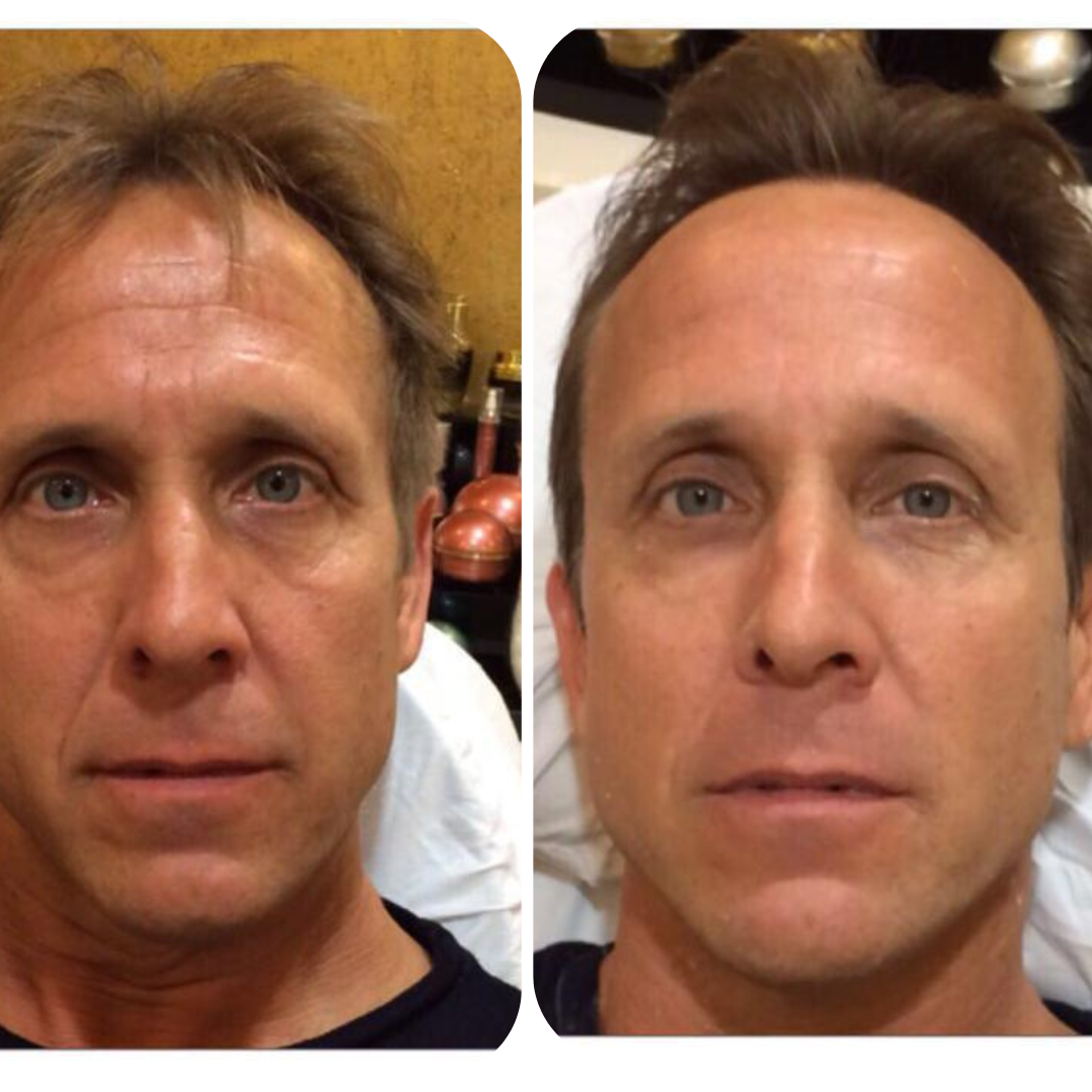 Before and after LED treatment result 4