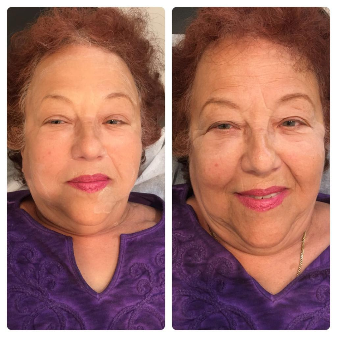 Before and after LED treatment result 6