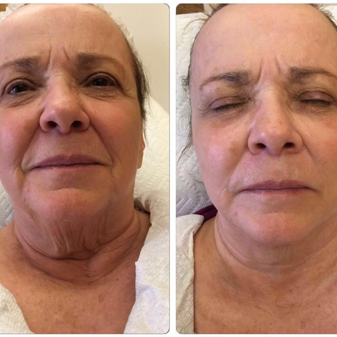 Before and after LED treatment result 7